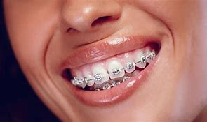 Braces