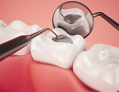 Dental Fillings